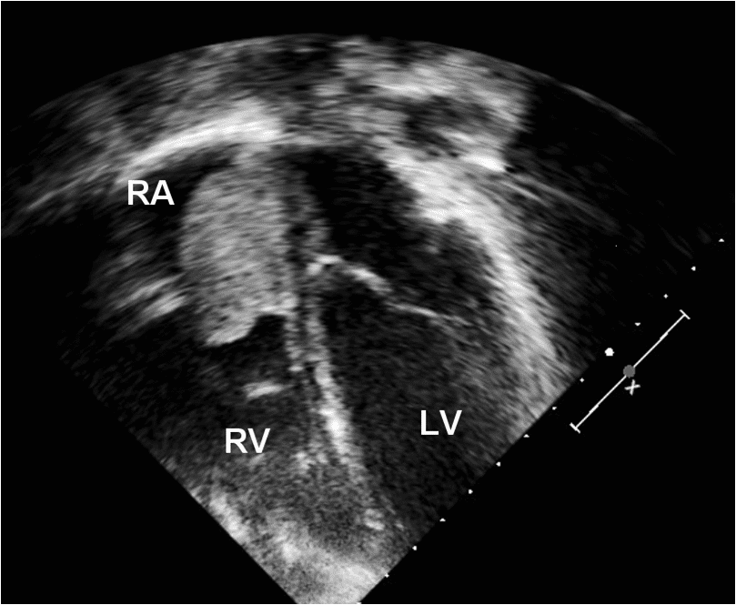 Image 1: ECHO atrial myxoma